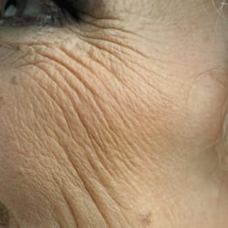 Dry Dehydrated Skin