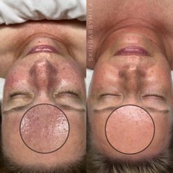 Skin Bar by Mila - After te treatments & a customized skincare regimen