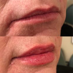 Revitalessence Medical Spa & Laser Center - Thank you for the lips!