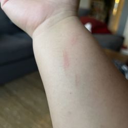 Piedmont Family Spa - This is the scratch from her nail.