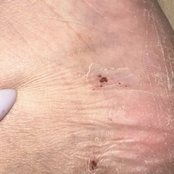 Hawaiian Nail Bar - Chemical burns