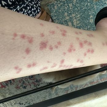 LaserAway - This is my lower leg 4 days after treatment. - Medical Spas Near Me - Las Vegas, Nevada LaserAway - This is my lower leg 4 days after treatment. - Medical Spas Near Me - Las Vegas, Nevada