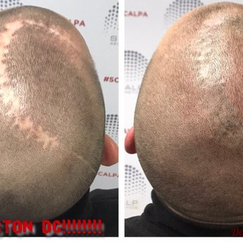 Scalp Allure - Scar camouflage treatment - Hair Loss Centers Near Me - Bethesda, Maryland Scalp Allure - Scar camouflage treatment - Hair Loss Centers Near Me - Bethesda, Maryland