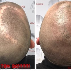 Scalp Allure - Scar camouflage treatment
