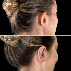Chris Devulapalli, MD - Otoplasty