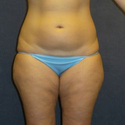 Eric P Bachelor, MD, FACS - Female, 41 yr old BEFORE LIPOSUCTION