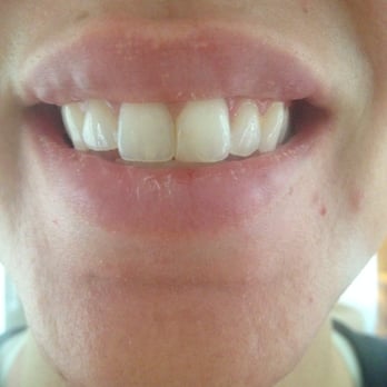 Interface Aesthetic Surgery Group - Awesome superficial lumps from Interface - Cosmetic Surgeons Near Me - Carmel, Indiana