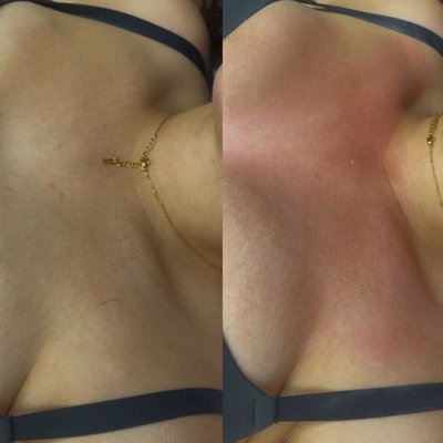 Torso/Back waxes - Before and afters of our chest, stomach and back waxes