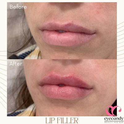 FILLER - Make you look fullfill with these filler
Text 📲: (949)-877-0256
Call 📞: (562)-402-1888
Website 💻: www.eyecandylashandbrowspa.com FILLER - Make you look fullfill with these filler
Text 📲: (949)-877-0256
Call 📞: (562)-402-1888
Website 💻: www.eyecandylashandbrowspa.com