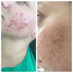 PS Skincare - Before & After 1 month results