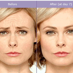Skin Day Spa - Botox before and after!