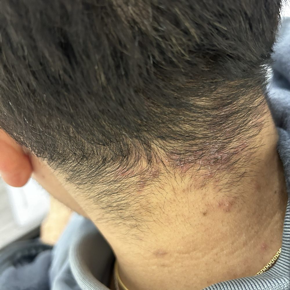 Bacterial folliculitis