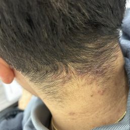 Bacterial folliculitis Bacterial folliculitis
