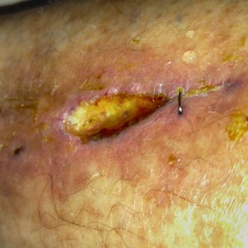 Enterprise Rent-A-Car - Staples pulled out from swelling - Car Rental Near Me - Houston, Texas