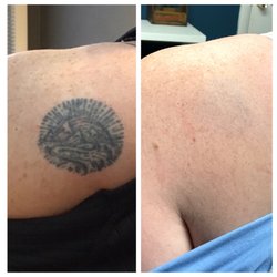 Disappearing inc. - Where'd my shoulder tattoo go?