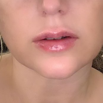 Face Forward Aesthetics - A few hours after lip filler. - Medical Spas Near Me - Henderson, Nevada Face Forward Aesthetics - A few hours after lip filler. - Medical Spas Near Me - Henderson, Nevada