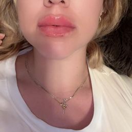 Lip filler & Lip Flip