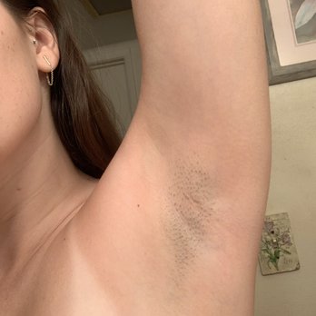 SEV Laser - Before 1st treatment - Laser Hair Removal Near Me - Calabasas, California