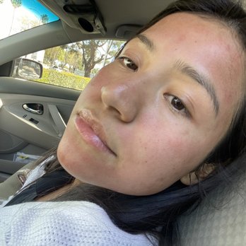 Daisy MD Care - My face after the microneedling. Its Red, but it's normal this is for the scars, which I have. - Skin Care Near Me - Downey, California
