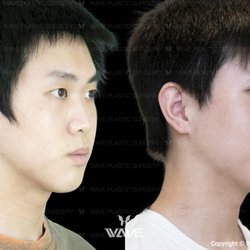 Wave Plastic Surgery - Left is before and Right is after an Upper Bleph on this patient.