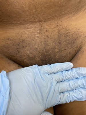 Brazilian Waxing - Hair is removed from the pubic region, the inner/outer labia. With or without the inner buttocks. A thin strip or a triangle of hair can be left, if desired. Hard wax is used for this service.