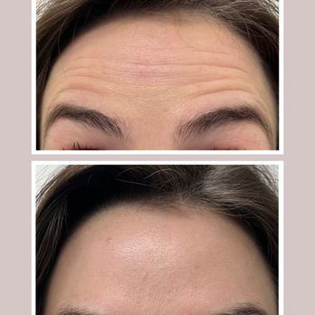 Yarrow Beauty - Botox before and after - IV Hydration Near Me - Albany, Oregon Yarrow Beauty - Botox before and after - IV Hydration Near Me - Albany, Oregon