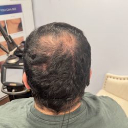 Arden Creek Laser & Aesthetics - Male pattern baldness: hair restoration therapy