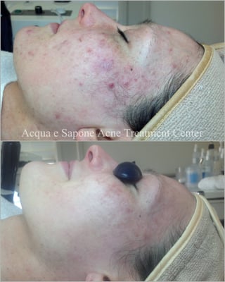 AES Acne Clinic by null