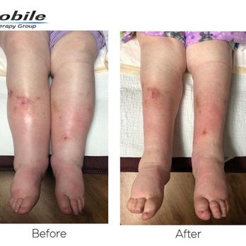 The Mobile Therapy Group - This is one of our patient's amazing results after only 6 weeks of lymphedema treatment! - Physical Therapy Near Me - Oklahoma City, Oklahoma The Mobile Therapy Group - This is one of our patient's amazing results after only 6 weeks of lymphedema treatment! - Physical Therapy Near Me - Oklahoma City, Oklahoma