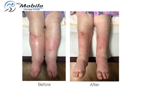 Lymphedema Treatment - This is one of our patient’s amazing results after only 6 weeks of lymphedema treatment! If you suffer from uncontrolled swelling, you may benefit from Manual Lymphatic Drainage therapy from one of our Certified Lymphedema Therapists. Talk to your physician or contact us today to get started. Lymphedema Treatment - This is one of our patient’s amazing results after only 6 weeks of lymphedema treatment! If you suffer from uncontrolled swelling, you may benefit from Manual Lymphatic Drainage therapy from one of our Certified Lymphedema Therapists. Talk to your physician or contact us today to get started.