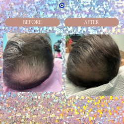 Aesthetics Care Med Spa - Hair PRP after 6 session