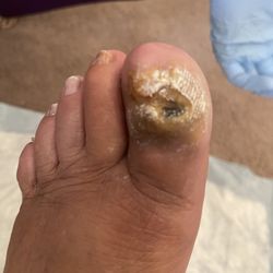 Foot Institute - Calgary - Risking losing my toe.