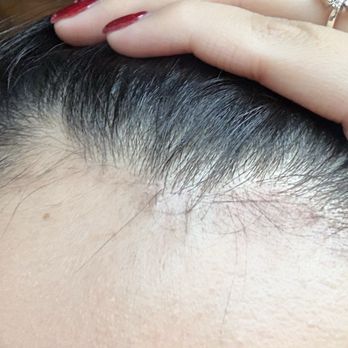 LuminHair - Burned off hairline & thinning after employee used rubbing alcohol to remove hair dye that's wasn't even on hair no longer than 15 mins - Hair Salons Near Me - Duluth, Georgia LuminHair - Burned off hairline & thinning after employee used rubbing alcohol to remove hair dye that's wasn't even on hair no longer than 15 mins - Hair Salons Near Me - Duluth, Georgia