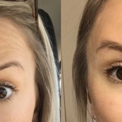 Age Management Institute - Before and after Botox to soften forehead lines
