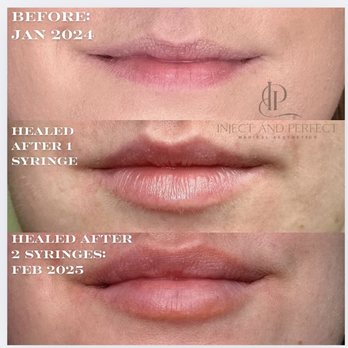 Inject and Perfect Med Spa - Lip filler built over time - Skin Care Near Me - Plaistow, New Hampshire