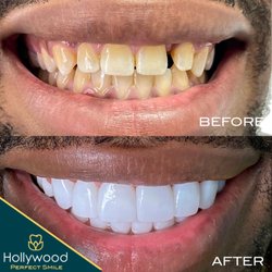 Hollywood Perfect Smile - Real patient