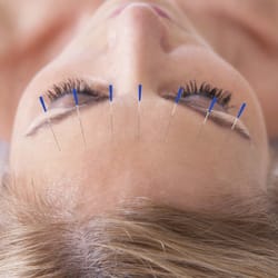 NatureMed Acupuncture