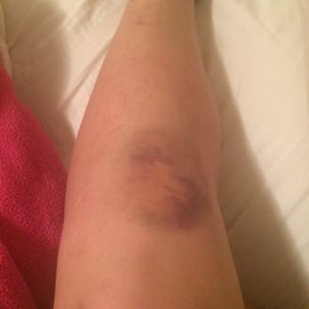 Sea Thai - The bruise that had developed since falling at the restaurant. - Thai Near Me - Brooklyn, New York Sea Thai - The bruise that had developed since falling at the restaurant. - Thai Near Me - Brooklyn, New York