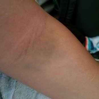 Diagnostic Laboratory Services - 2 days after the bruise has gotten bigger. Picture quality isn't great but I'm def never going back there again. - Laboratory Testing Near Me - Kapolei, Hawaii Diagnostic Laboratory Services - 2 days after the bruise has gotten bigger. Picture quality isn't great but I'm def never going back there again. - Laboratory Testing Near Me - Kapolei, Hawaii
