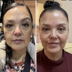 Prejuvenation Aesthetics - 2 weeks difference left is beginning right is 2 weeks after. I'm happy my eyebrows are lookin more symmetrical. So happy