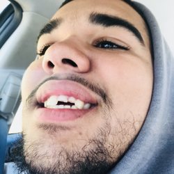 Washington Street Family Dentistry - He broke two teeth on a pogo stick!!