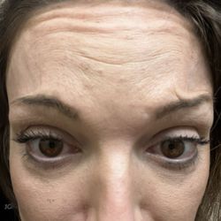 Love Medical Spa - This is 2 weeks after the injections I received. The wrinkle in my eyebrow, wasn't there prior to the injections