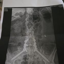 Gulf Orthopaedics | Hillcrest - Sacral repair