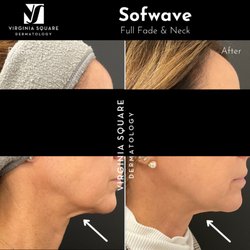 Virginia Square Dermatology - Skin tightening at Virginia Square Dermatology