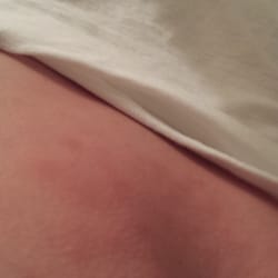 Banner Health Clinic: General Surgery - Evident redness, swelling, rash. Admitting notes read, "...no visible skin abnormalities, nor edema". !?!