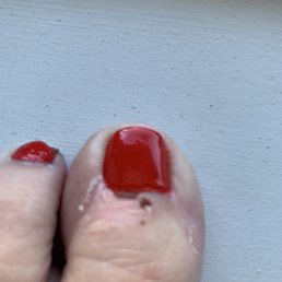 Cut and scabbed cuticle.