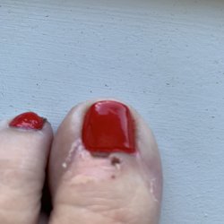LaBelle Nails & Spa - Cut and scabbed cuticle.