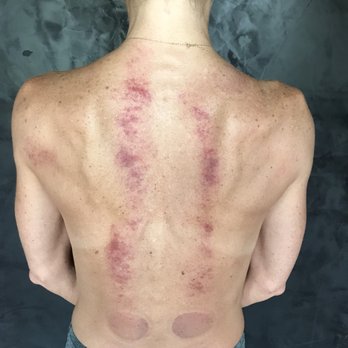 Mending Roots Body Therapies - Guasha Therapy marks - only lasted 2 - 4 days! Worth it! - Massage Therapy Near Me - Eureka, California