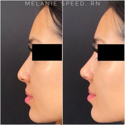 The Beverly Hills Medspa - Before and after non surgical nose job by Melanie Speed, RN.