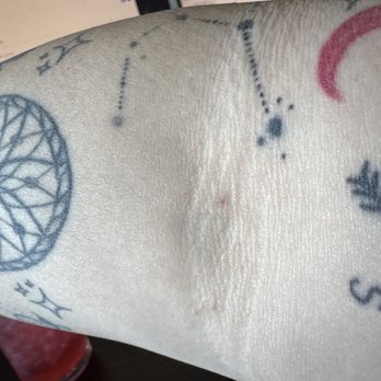 Labcorp - My arm the next day! - Laboratory Testing Near Me - Longmont, Colorado Labcorp - My arm the next day! - Laboratory Testing Near Me - Longmont, Colorado